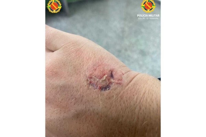 Policial militar tem mão mordida por dona de restaurante após briga no estabelecimento -  (crédito: PMDF/Divulgação)