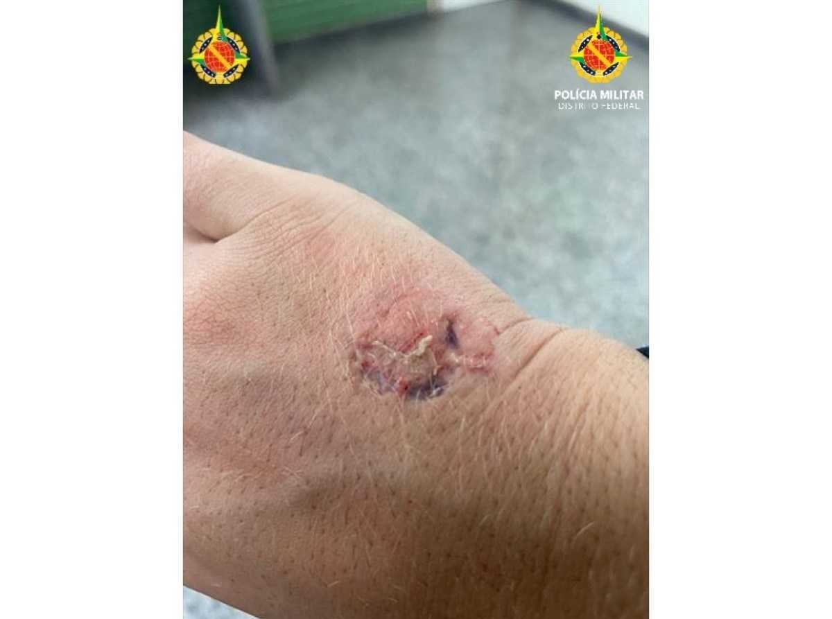 Policial militar tem mão mordida por dona de restaurante após briga no estabelecimento