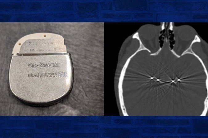 O dispositivo e a tomografia computadorizada  com os eletrodos 