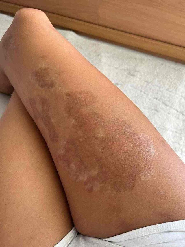A doença esclerodermia que Camila Nilce desenvolveu deixou manchas e marcas pelo seu corpo. 