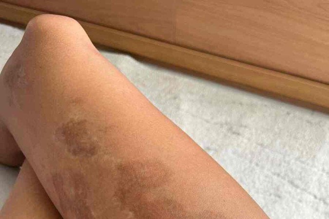 A doença esclerodermia que Camila Nilce desenvolveu deixou manchas e marcas pelo seu corpo 