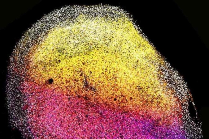 Organoide cerebral: 
as células-tronco são marcadas 
em cinza e as neuronais 
são codificadas por rosa e amarelo com base na profundidade
 -  (crédito: Princess Máxima Center/Hubrecht Institute)