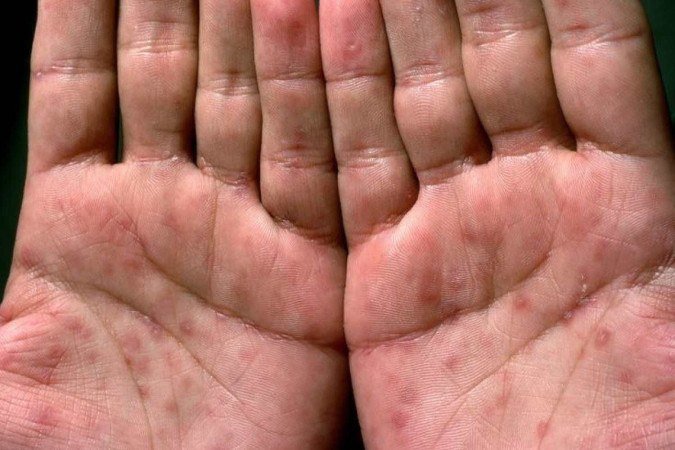 Manchas nas palmas das mãos e plantas dos pés são sinais de que a sífilis está no estágio secundário. Essas lesões podem desaparecer sozinhas, trazendo a falsa impressão de cura.