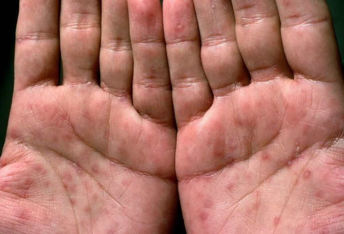 Manchas nas palmas das mãos e plantas dos pés são sinais de que a sífilis está no estágio secundário. Essas lesões podem desaparecer sozinhas, trazendo a falsa impressão de cura.