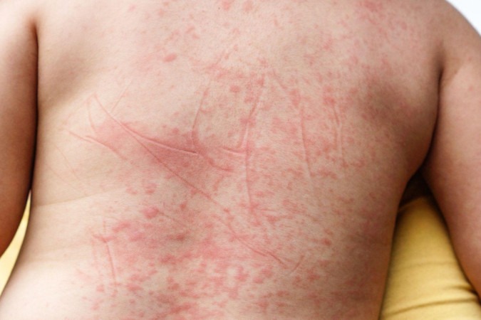 O aparecimento de manchas vermelhas na pele é um sintoma associado à febre hemorrágica da dengue -  (crédito: Getty Images)