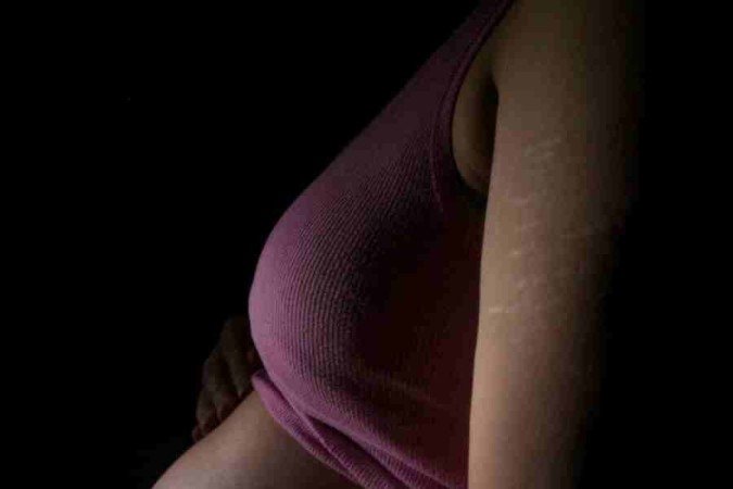 Mulheres na gravidez tendem a ter mais estrias