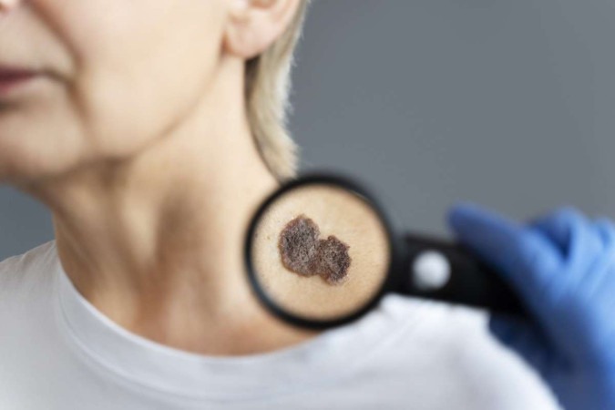 Os melanomas podem ser na cor marrom, irregulares ou planos, e caroços pretos ou cinzentos -  (crédito: Freepik/Divulgação)