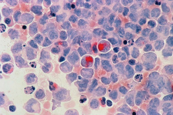O tumor afeta os glóbulos brancos do sangue, responsáveis por defender o corpo contra organismos infecciosos e substâncias estranhas -  (crédito: National Cancer Institute/Unsplash)