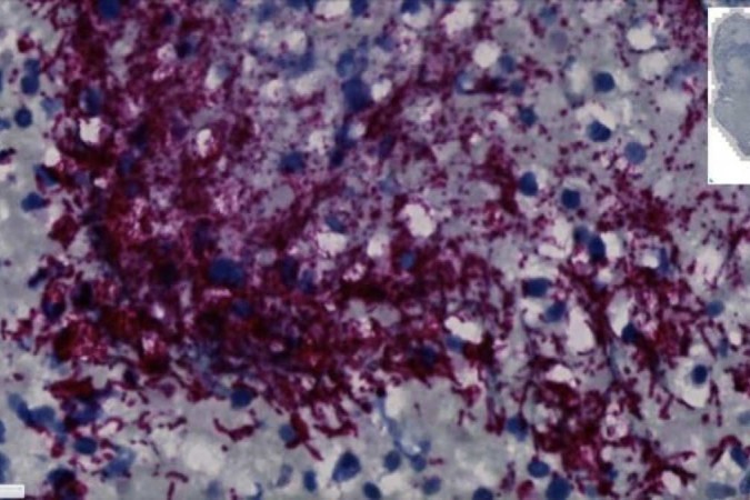 Uma imagem de microscópio mostra um tumor de câncer colorretal humano com Fusobacterium nucleatum corado em uma cor vermelho-púrpura. A bactéria é comumente encontrada na boca das pessoas. Os pesquisadores da Fred Hutch descobriram um subtipo específico de F. nucleatum que pode se mover para o intestino, onde ajuda o câncer colorretal a crescer.

CRÉDITO
Centro de Câncer Fred Hutchinson -  (crédito: Fred Hutchinson Cancer Center/Divulgação )