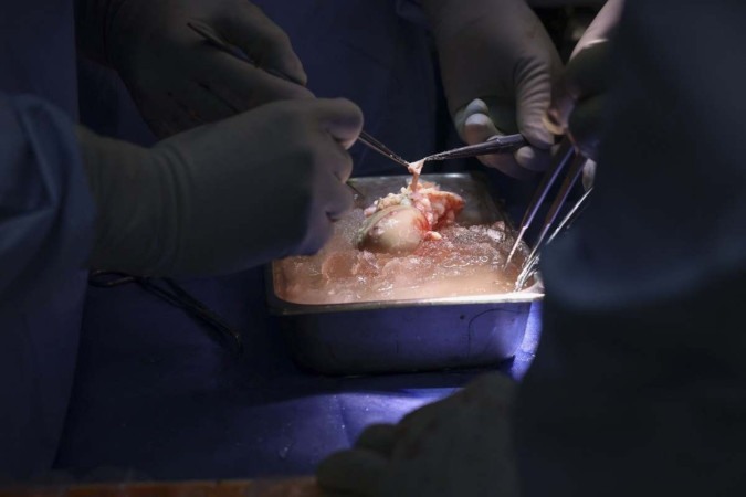 O material transplantado passou por 69 edições genéticas antes da operação -  (crédito: AFP)