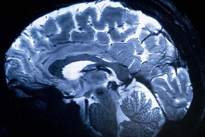 Detalhes do cérebro em exame realizado na França -  (crédito:  AFP)