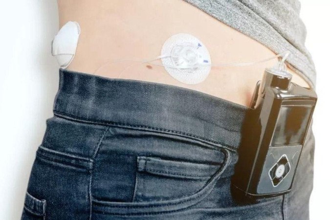 Diabetes: Reino Unido se torna 1º a oferecer 'pâncreas artificial' na rede pública -  (crédito: BBC)