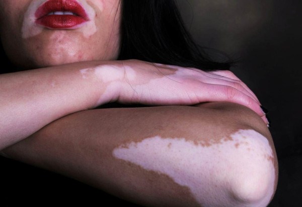 O vitiligo pode surgir 