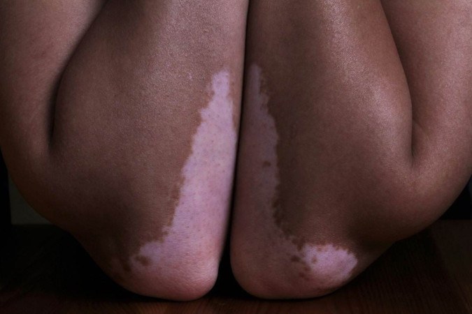 Mesmo que não possa ser curado, existem várias opções de tratamento para o quadro de vitiligo. -  (crédito: Reprodução/Pinterest/@hanenboubahri)
