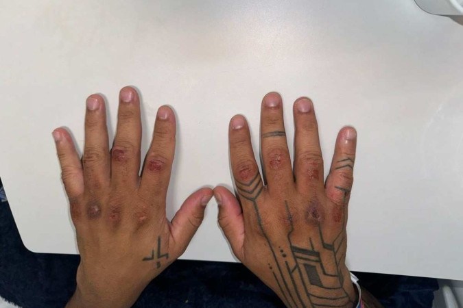 Marcas mostram ferimentos nas mãos de soldado -  (crédito: Material cedido ao Correio)