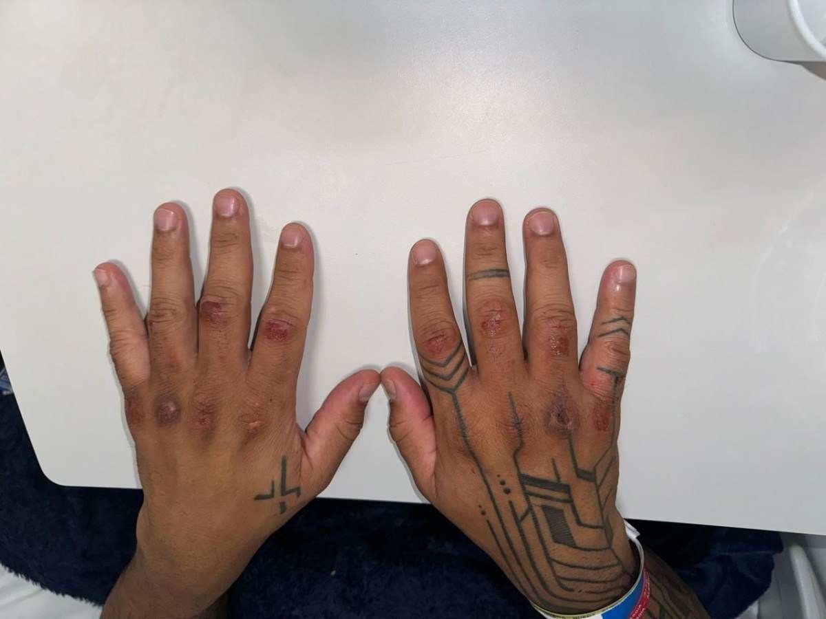 Marcas mostram ferimentos nas mãos de soldado