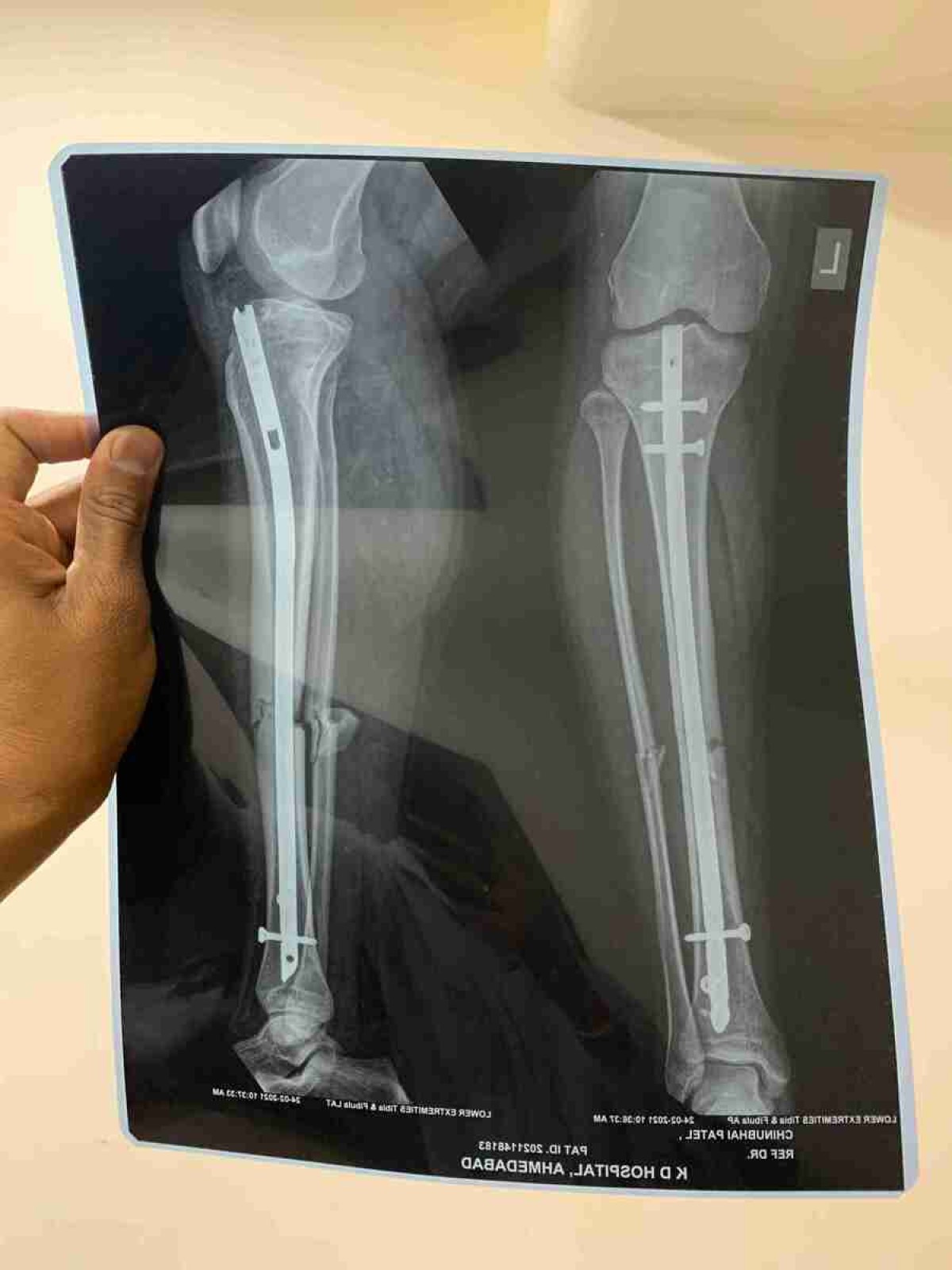 Menina de 6 anos cai de bicicleta e médicos colocam pino em perna errada