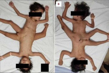 A cirurgia ocorreu quando os gêmeos tinham três anos de idade. -  (crédito: Reprodução/American Journal of Case Reports)