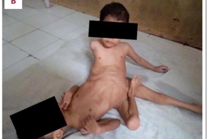 "Gêmeos aranha": siameses que nasceram com sete membros passam por cirurgia