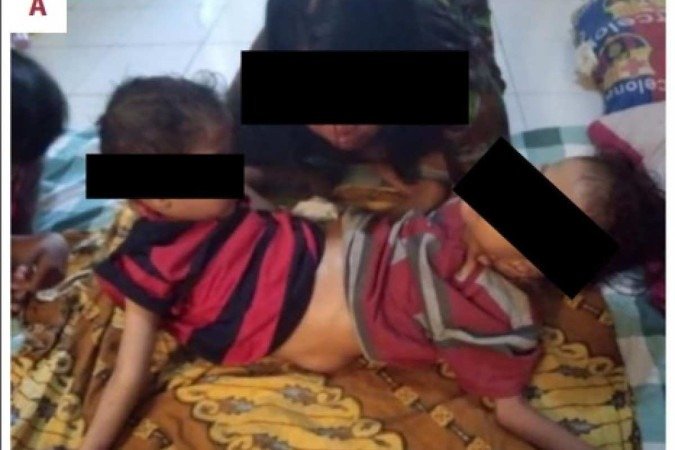 "Gêmeos aranha": siameses que nasceram com sete membros passam por cirurgia