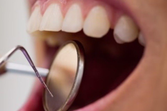 Quando discutida com o especialista dental, a vida sexual pode prevenir o câncer de orofaringe, que afeta boca, língua, palato e faringe - (crédito: Freepik) Quando discutida com o especialista dental, a vida sexual pode prevenir o câncer de orofaringe, que afeta boca, língua, palato e faringe - (crédito: Freepik)
