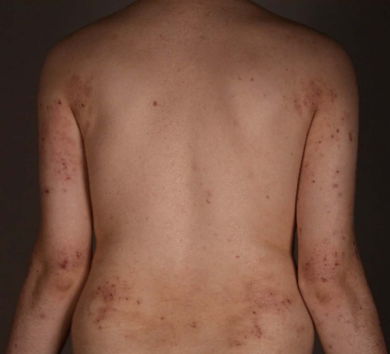 Artigo: Dermatite atópica e seus impactos além da pele