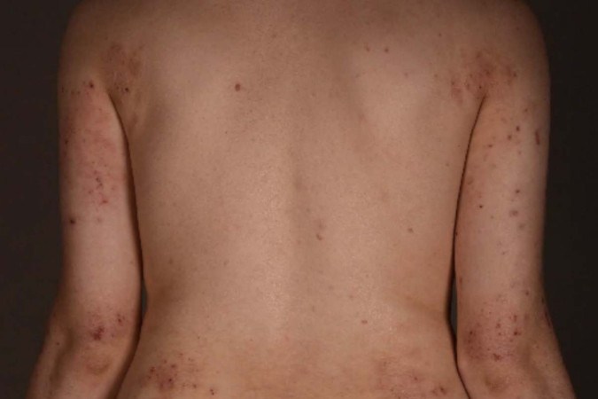 Dermatite atópica -  (crédito: Dermatologische Klinik, USZ)