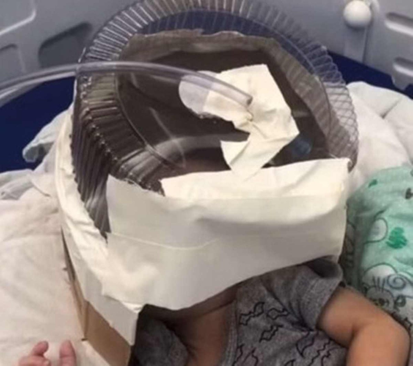 Hospital usa embalagem de bolo como máscara de oxigênio em bebê