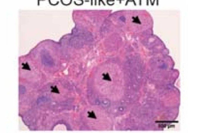 Célula tratada com artemisinina
