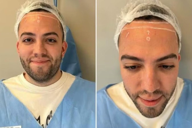 Influenciador Lucas Rangel faz cirurgia para reduzir tamanho da testa -  (crédito: Observatorio dos Famosos)