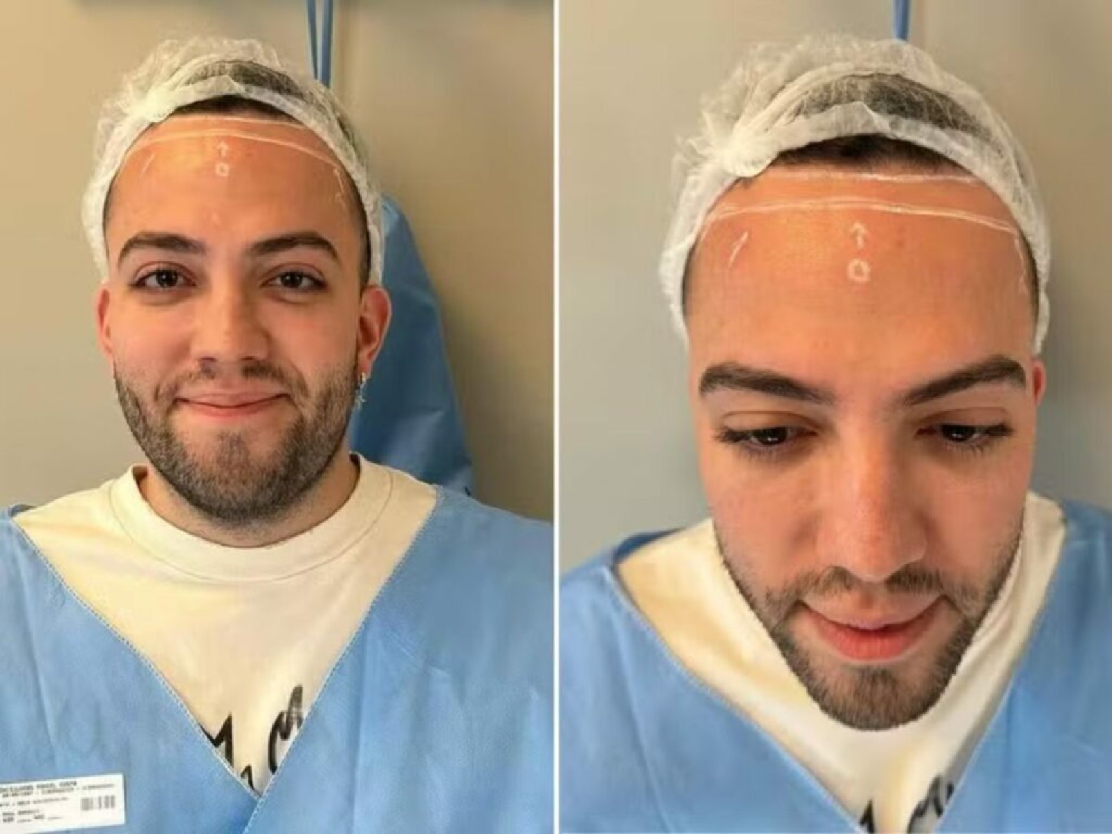 Influenciador Lucas Rangel faz cirurgia para reduzir tamanho da testa