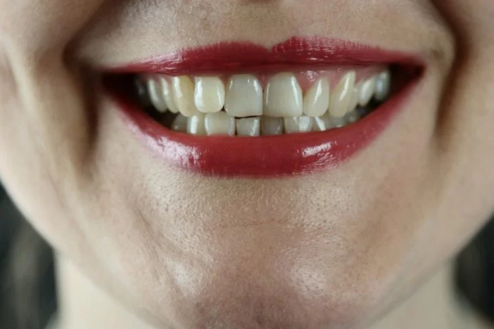 A escolha da melhor solução para cada caso dependerá de diversos fatores, como a quantidade de dentes perdidos, a saúde bucal do paciente e o orçamento disponível. -  (crédito: Marek Studzinski Unsplash)