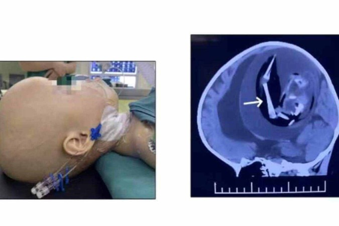 Uma tomografia computadorizada do crânio mostrou tecidos moles e ossos, de forma semelhante a um membro, na área intracraniana -  (crédito: American Journal of Case Reports)