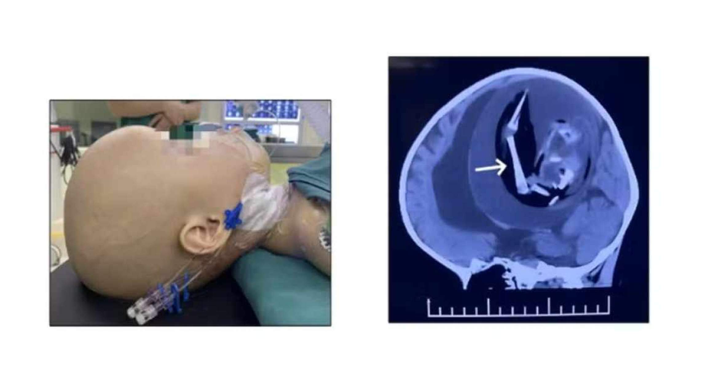 Feto parasita de 18 cm é retirado da cabeça de bebê de 1 ano na China