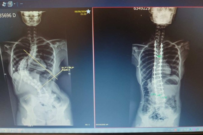 Cirurgia para correção de curvatura na coluna da menina, realizada no HCM de Rio Preto, durou cerca de seis horas