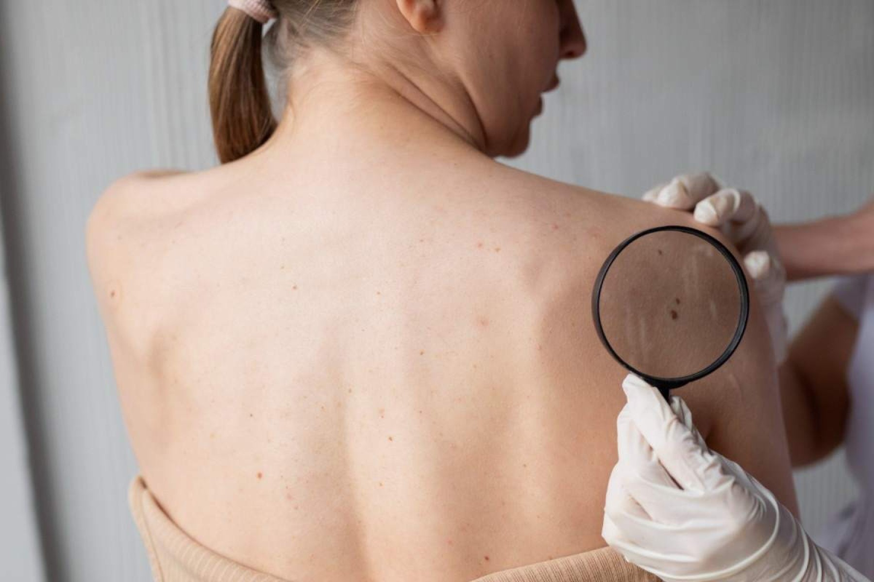 Câncer de pele: especialista alerta para exposição ao sol no inverno