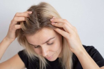 A caspa é uma condição comum que se caracteriza pela descamação da pele no couro cabeludo, resultando em pequenas partículas brancas ou amareladas -  (crédito: Freepik)