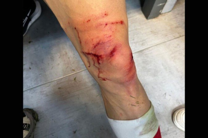 estiário, atacante do Huracán indica ferimentos na perna, após chegada atrasada de zagueiro do San Lorenzo no Campeonato Argentino - (crédito: Foto: Reprodução / Instagram @pedropdispa) estiário, atacante do Huracán indica ferimentos na perna, após chegada atrasada de zagueiro do San Lorenzo no Campeonato Argentino - (crédito: Foto: Reprodução / Instagram @pedropdispa)