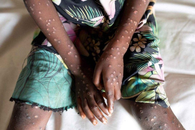 O vírus monkeypox é transmitido através do contato próximo com pessoas infectadas -  (crédito: BBC )