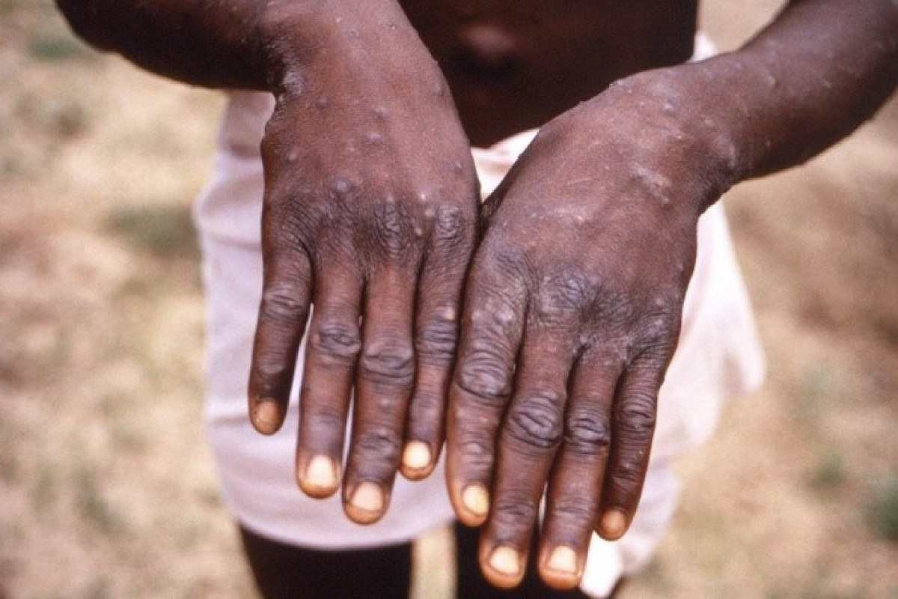 Casos de mpox disparam em 160% na África e OMS decreta emergência global