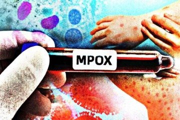 Até o momento, 81 casos foram registrados no Brasil - (crédito: Maurenilson Freire) Até o momento, 81 casos foram registrados no Brasil - (crédito: Maurenilson Freire)