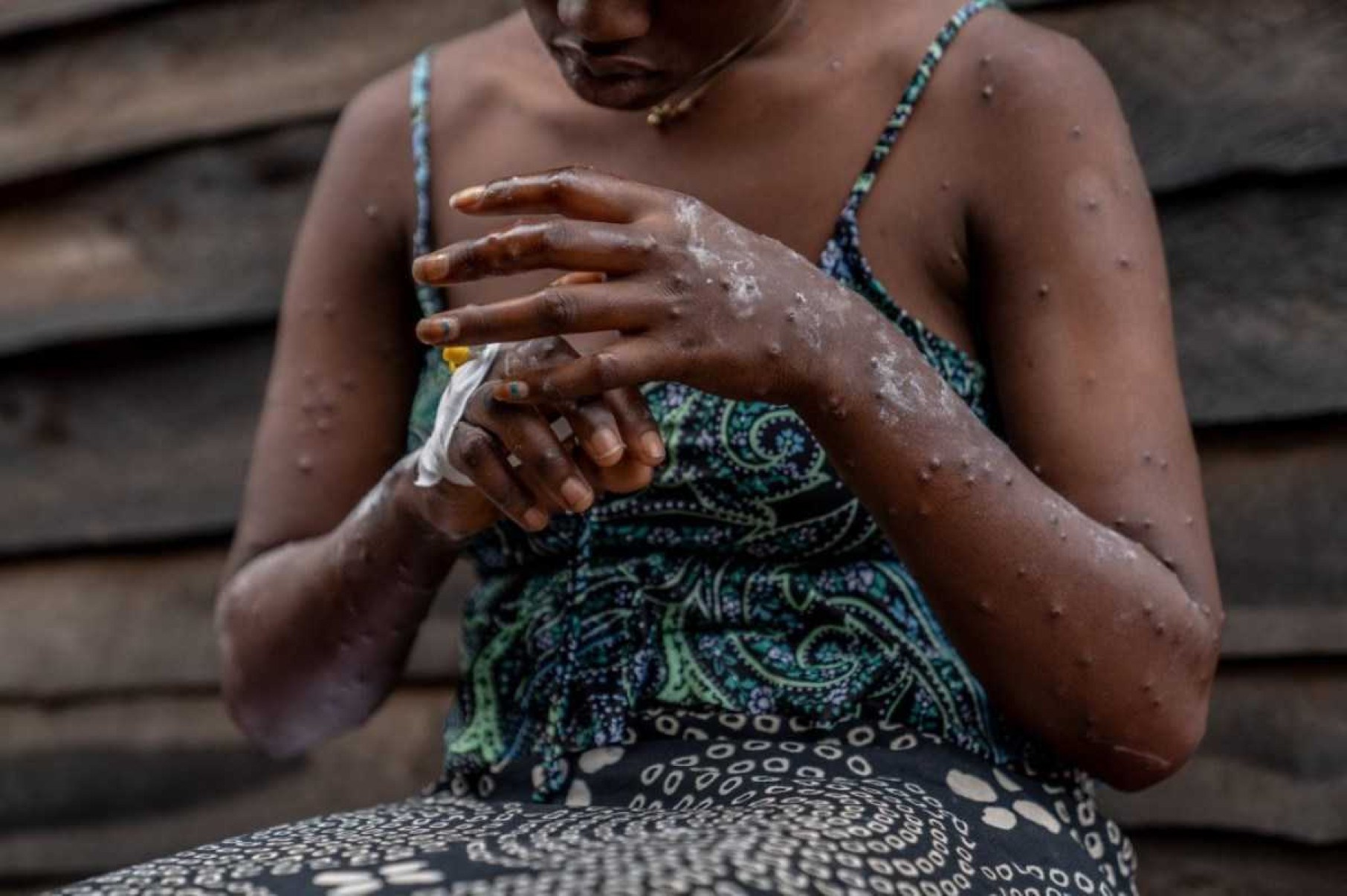 São Paulo concentra mais da metade dos casos de mpox no Brasil