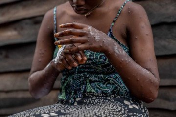 Um paciente que sofre de mpox está sentado em um banco do hospital de Kavumu, 30 km ao norte de Bukavu, no leste da República Democrática do Congo, em 24 de agosto de 2024. -  (crédito: Glody MURHABAZI / AFP)