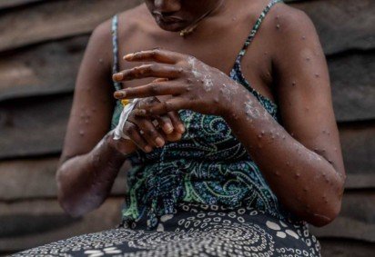 Doenças causadas pela família dos Orthopoxvirus, como a Mpox, podem emergir -  (crédito: Glody MURHABAZI / AFP) -Doenças causadas pela família dos Orthopoxvirus, como a Mpox, podem emergir -  (crédito: Glody MURHABAZI / AFP)