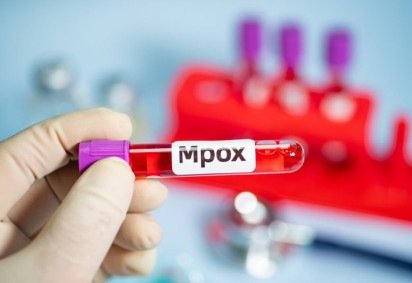 O caso de mpox foi o segundo do clado 1b no Estado -  (crédito: EdiCase) -O caso de mpox foi o segundo do clado 1b no Estado -  (crédito: EdiCase)