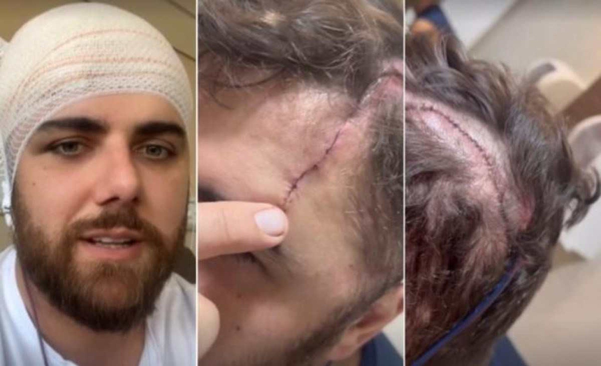 Zé Neto mostra cabeça toda costurada após grave acidente