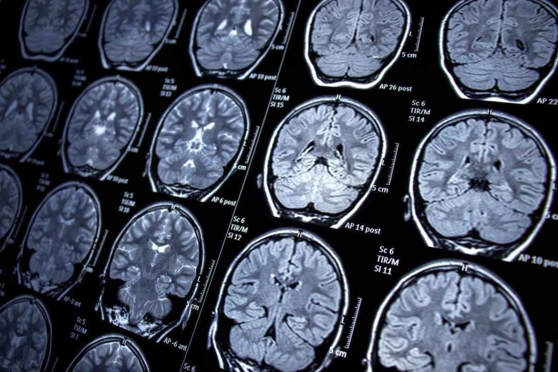 Sintomas persistentes: respostas estão no tronco cerebral