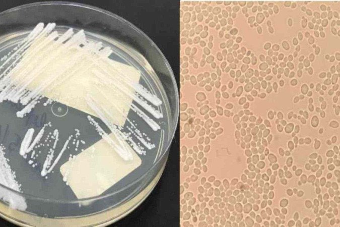 Outras 24 pessoas aguardam resultados da testagem do supefungo -  (crédito: Reprodução nota técnica GVIMS/GGTES/ANVISA / Laboratório de Micologia, Hospital das Clínicas da Faculdade de Medicina da USP, 2020)