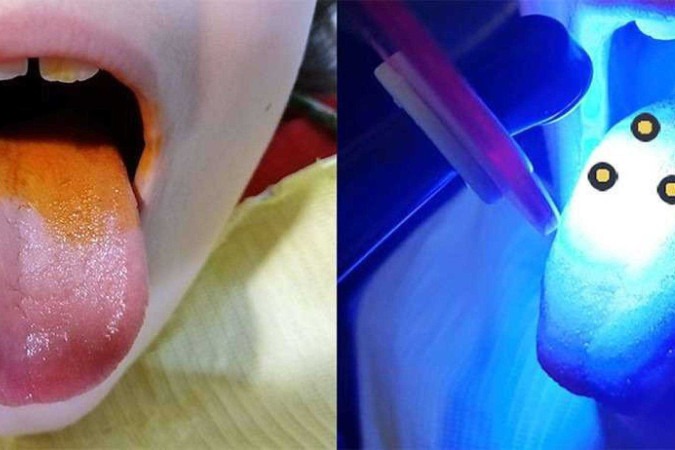 Tratamento é considerado acessível aos dentistas, já que maioria tem a fonte de luz utilizada na pesquisa em consultórios -  (crédito: Reprodução/PLOS ONE)