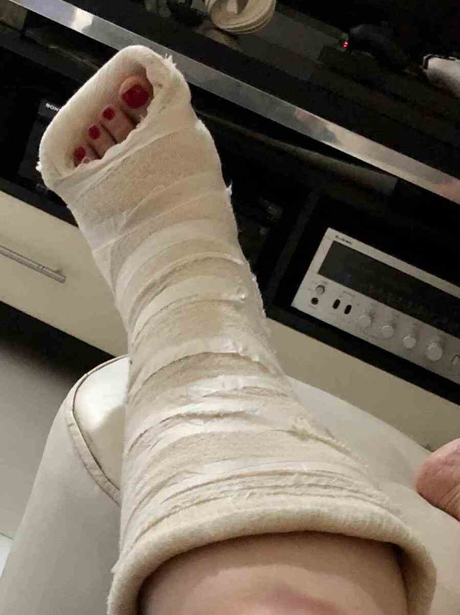 Simone ficou com a perna imobilizada com bota de gesso, por três meses 